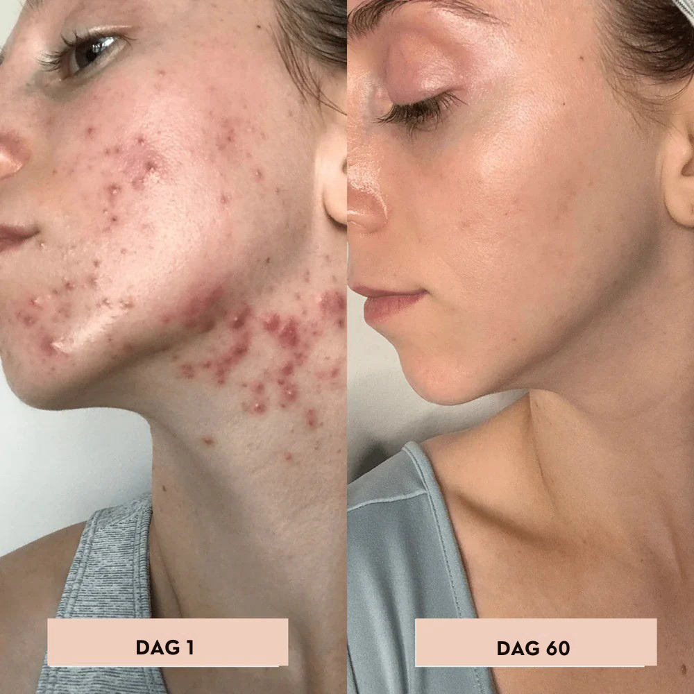 AcuDerma Aknebehandling