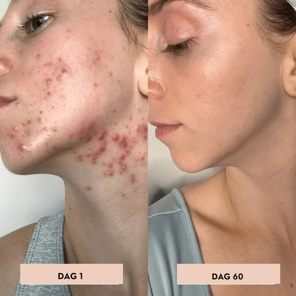 AcuDerma  Aknebehandling